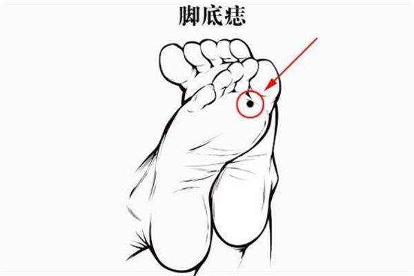 脚心有痣代表什么意思?