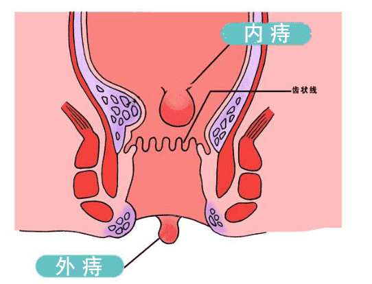 呼市东大肛肠医院大部分痔疮都是擦出来的90的人都不知道怎么擦屁股