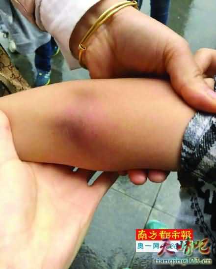 小男孩不慎踩到蜂巢 数十名游客被野蜂蜇伤