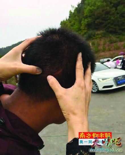 误踩蜂巢 游客被蜇