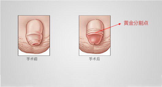 包皮环切术