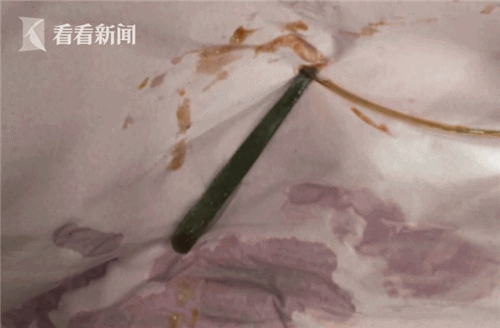 与女友吵架怒吞镊子 男子三个月不就医竟是忘了