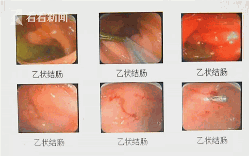 与女友吵架怒吞镊子 男子三个月不就医竟是忘了