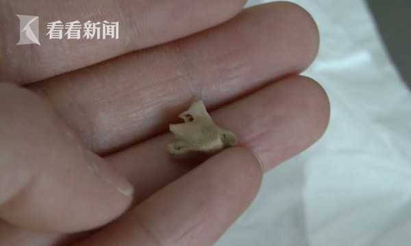鸭骨卡气管内