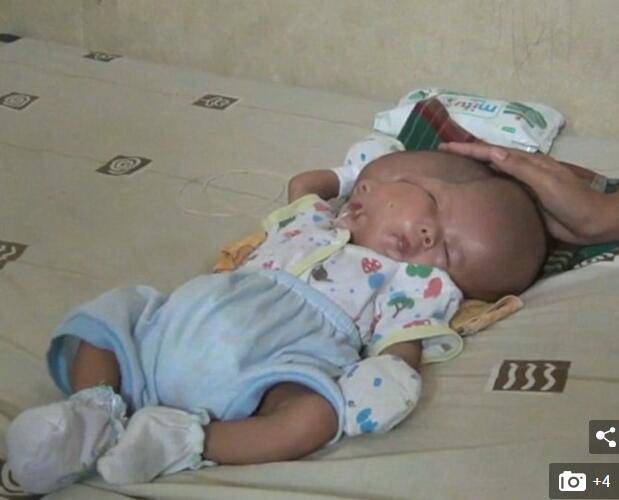 印尼一孕妈生下双面婴儿 因双胞胎发育失败所导致