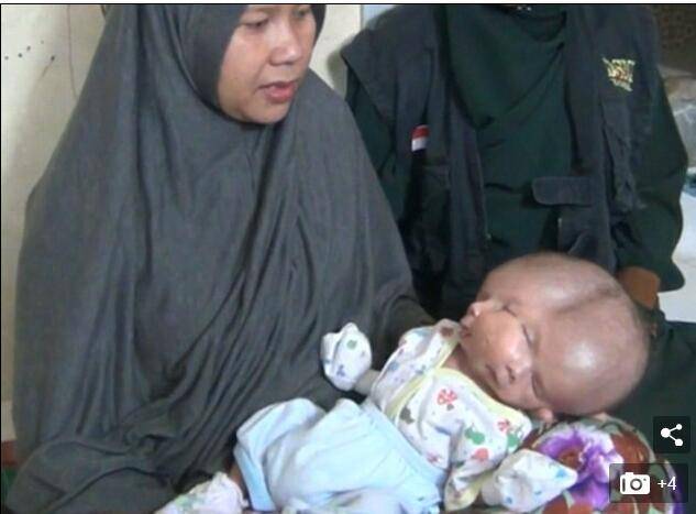 印尼一孕妈生下双面婴儿 因双胞胎发育失败所导致