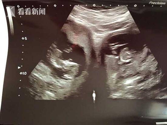 女子双子宫同时怀孕生两宝宝 生第一胎未发现异常