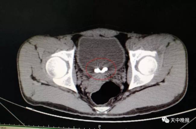 惊呆！驻马店18岁男孩膀胱里藏根40厘米长的电线