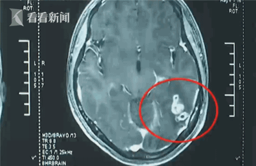 9公分活虫暗藏少女脑中12年 医生：已影响脑发育