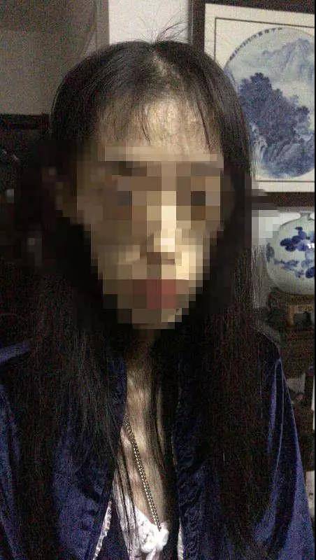 21岁女孩减肥至50斤，2次脑出血脑组织如60岁