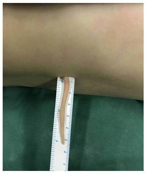 宝宝出生长了一条尾巴，6厘米“尾巴”有筷子粗