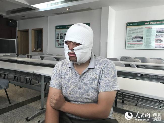 面部严重烧伤被遗弃 24岁小伙在武汉成功“换脸”