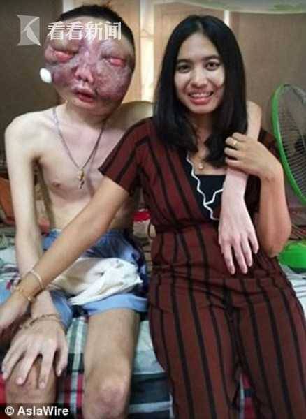 男子患癌整张脸变形模样恐怖 获女友陪伴多年离世