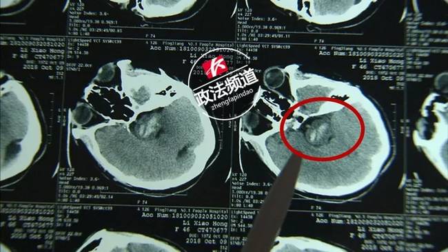 女子熬夜打麻将致颅内血管“爆” 仍未脱离危险