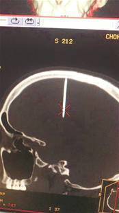 图为：CT片显示，胡师傅的右额颅内有根钉子