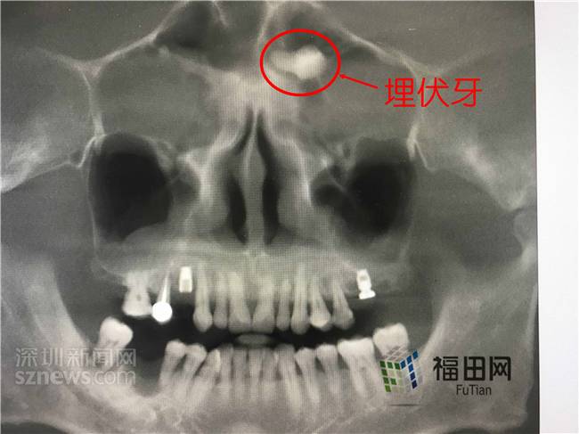 男子常年鼻塞流鼻涕 就医发现额头长了一颗