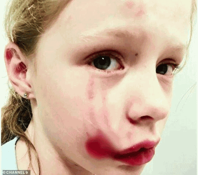 7岁女孩家门口遭大狗袭击 脸上被咬下一块肉