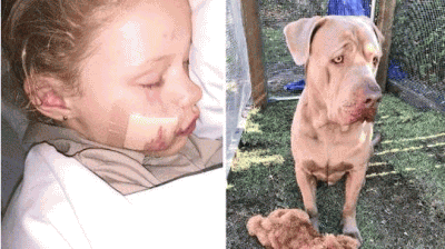 7岁女孩家门口遭大狗袭击 脸上被咬下一块肉