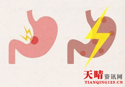 上海新华医院卞锦国教授讲解：胃溃疡离胃癌很