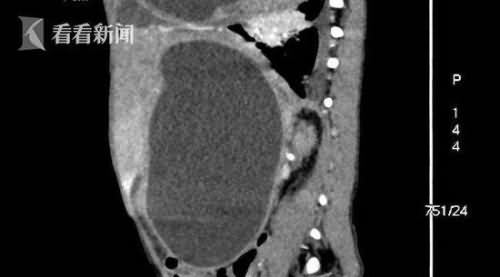 4岁男童肚子大如孕妇 医生从中抽出2斤寄生虫液