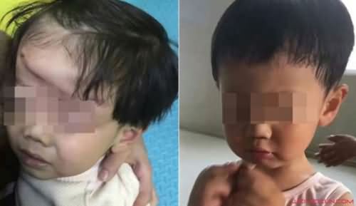 男童被游乐车挤伤致残