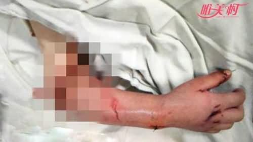 男孩被电梯夹断胳膊 男孩被电梯夹断胳膊