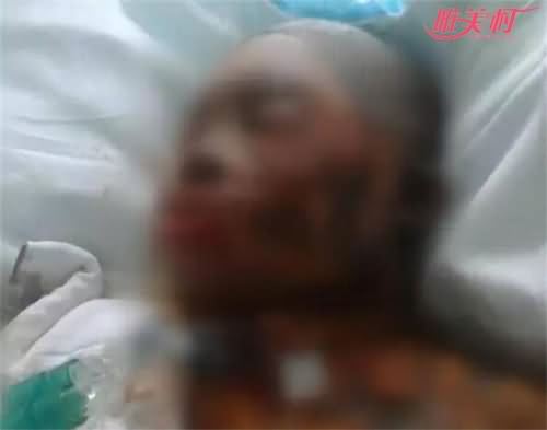 女子向男友泼热油