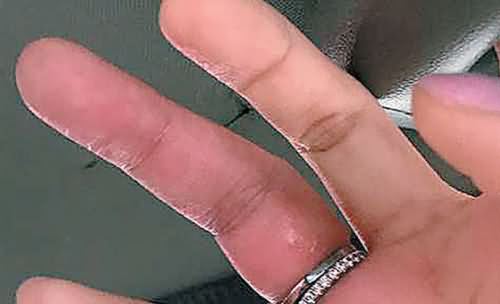 女星戒指戴太多险截肢 女星戒指戴太多险截肢