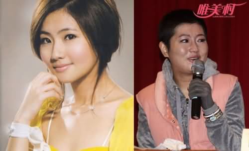 selina烧伤前后对比