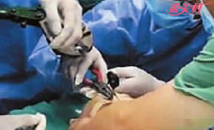 2岁女童眉骨戳进剪刀 2岁女童眉骨戳进剪刀