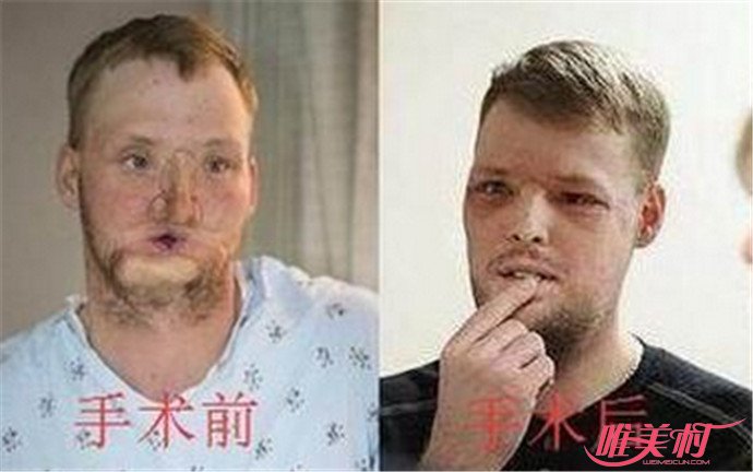 吞过子弹又怎样？美国男子吞枪被毁脸