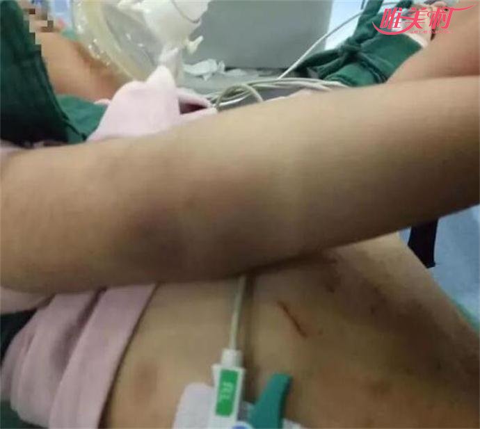 3岁女童遭后妈虐