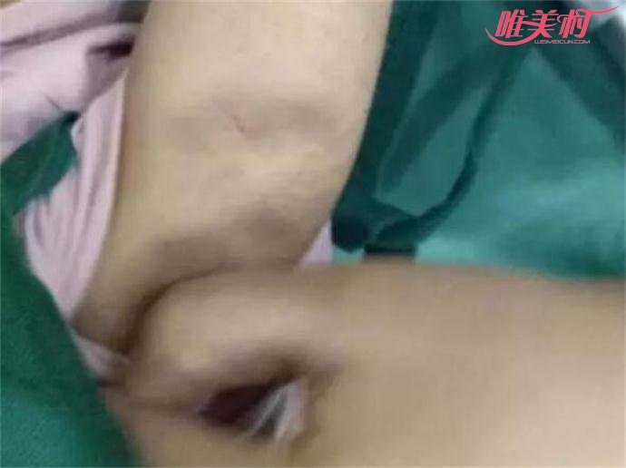 女童身上有多处淤青伤痕