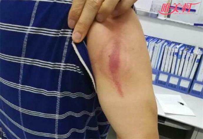 陆先生的胳膊的伤势 陆先生的胳膊的伤势