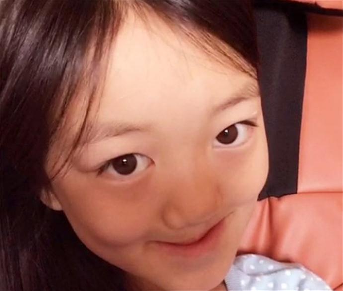 王菲女儿李嫣兔唇前后 王菲女儿李嫣兔唇前后