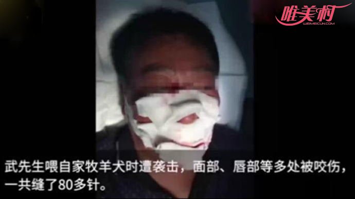 被牧羊犬袭击的男子
