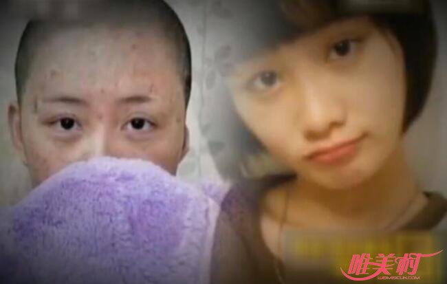 毁容少女周岩事件 毁容少女周岩事件
