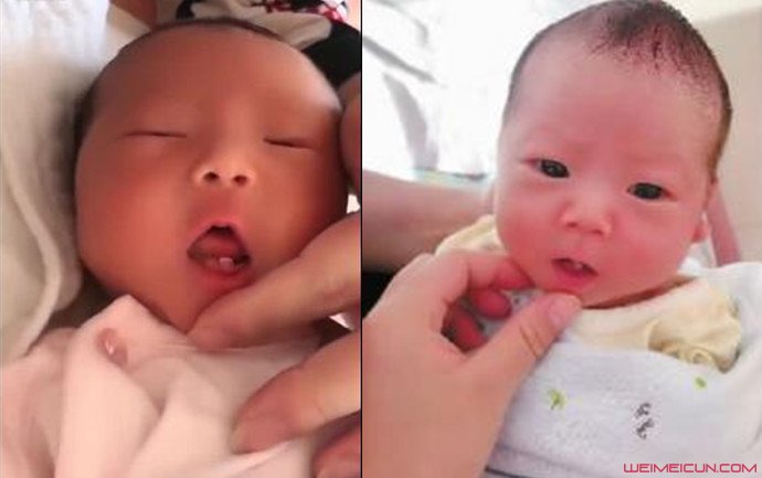 女婴出生长两颗牙 女婴出生长两颗牙
