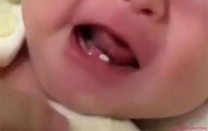 女婴出生长两颗牙 女婴出生长两颗牙