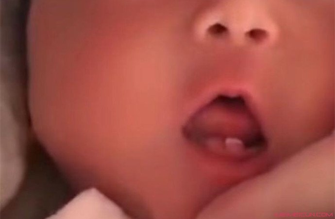 女婴出生长两颗牙 女婴出生长两颗牙