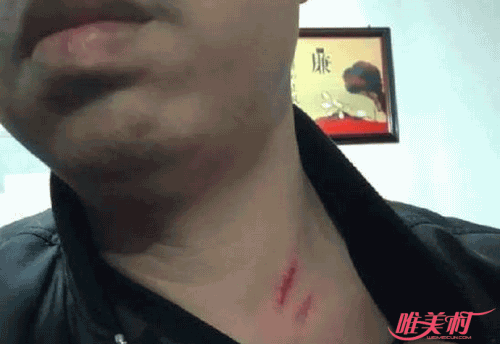 男子被强行做结扎 男子被强行做结扎