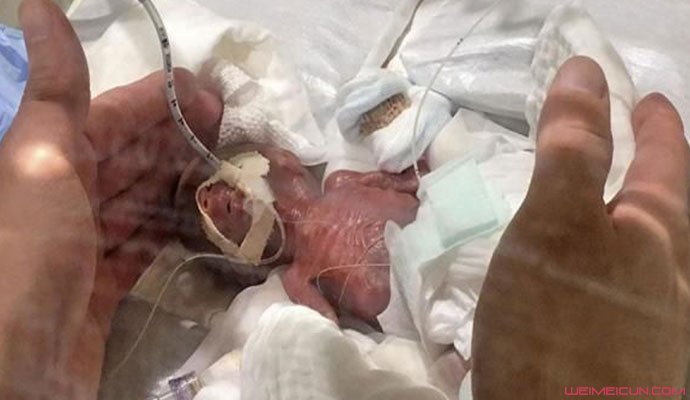 世界最小的男婴出院 世界最小的男婴出院