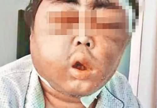 脸变肿胀 脸变肿胀