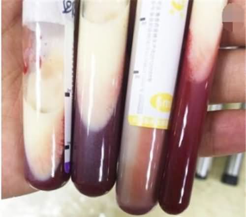 牛奶血是什么意思 男子抽出牛奶血三酯严重超标
