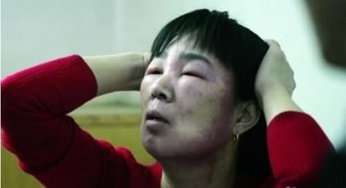 对于吃芒果严重过敏的朋友,用药后病情没有好转,看上面芒果过敏症状