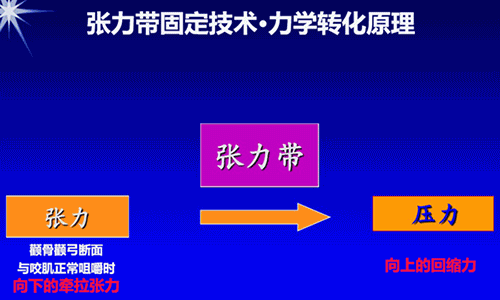 颧骨内推为什么首选张力带固定技术2021-1-18 14:31:26