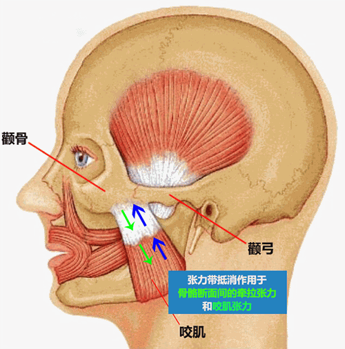 颧骨内推为什么首选张力带固定技术2021-1-18 14:31:36