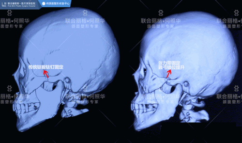颧骨内推为什么首选张力带固定技术2021-1-18 14:31:59