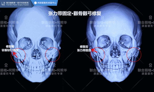 颧骨内推为什么首选张力带固定技术2021-1-18 14:30:36