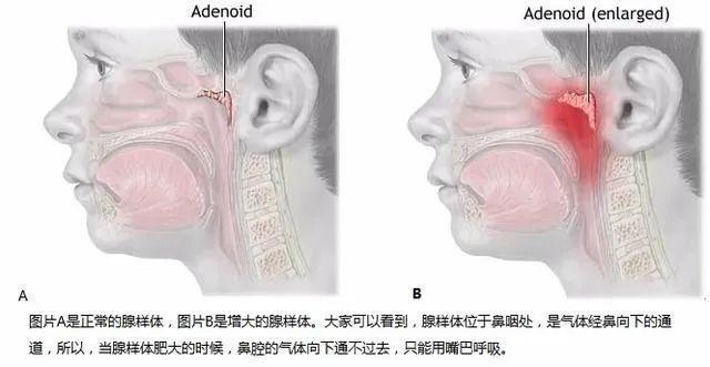 不同年龄段易患哪些耳鼻喉疾病2021-2-8 17:22:51